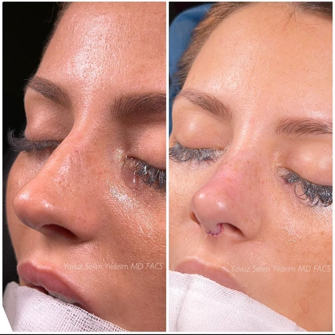 Before and after result by Dr. Yavuz Selim Yıldırım