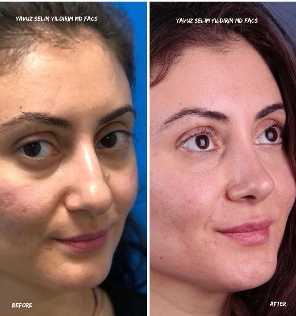 Before and after result by Dr. Yavuz Selim Yıldırım