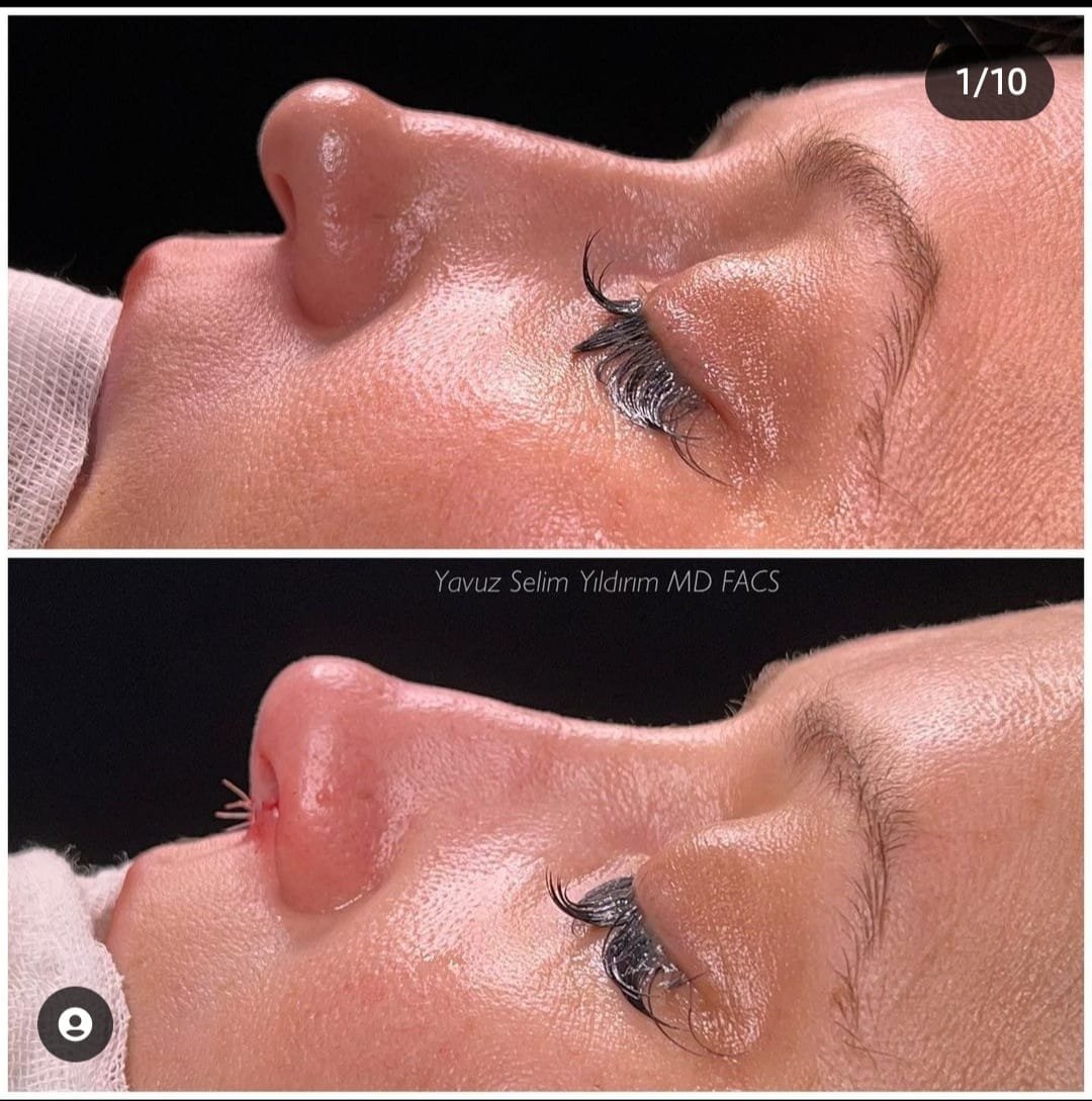 Before and after result by Dr. Yavuz Selim Yıldırım