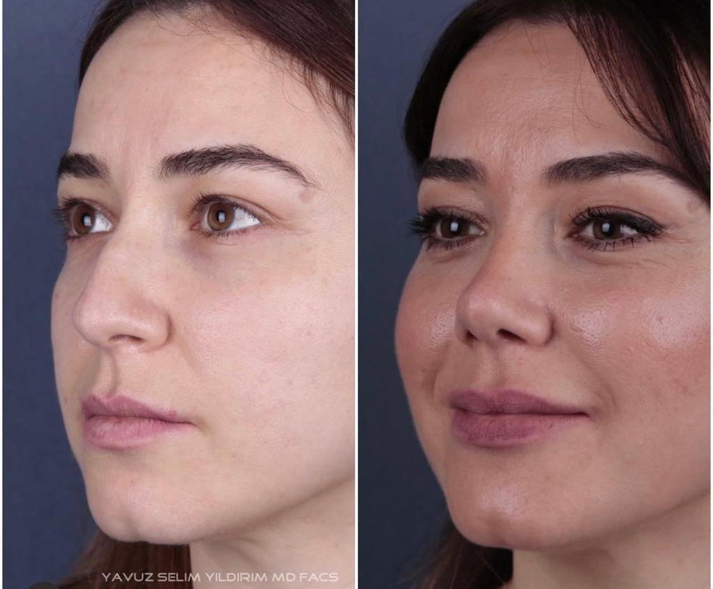 Before and after result by Dr. Yavuz Selim Yıldırım