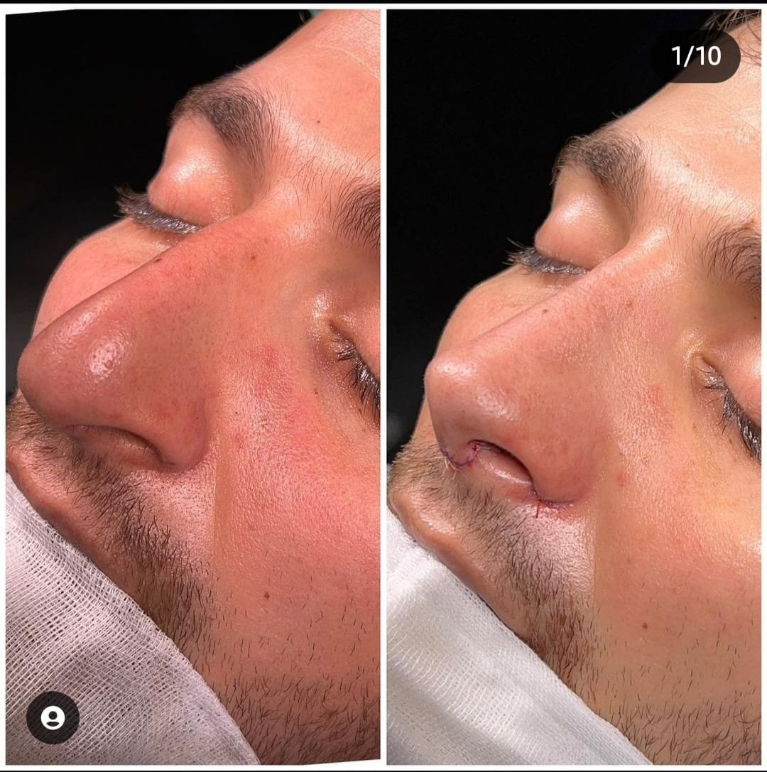 Before and after result by Dr. Yavuz Selim Yıldırım