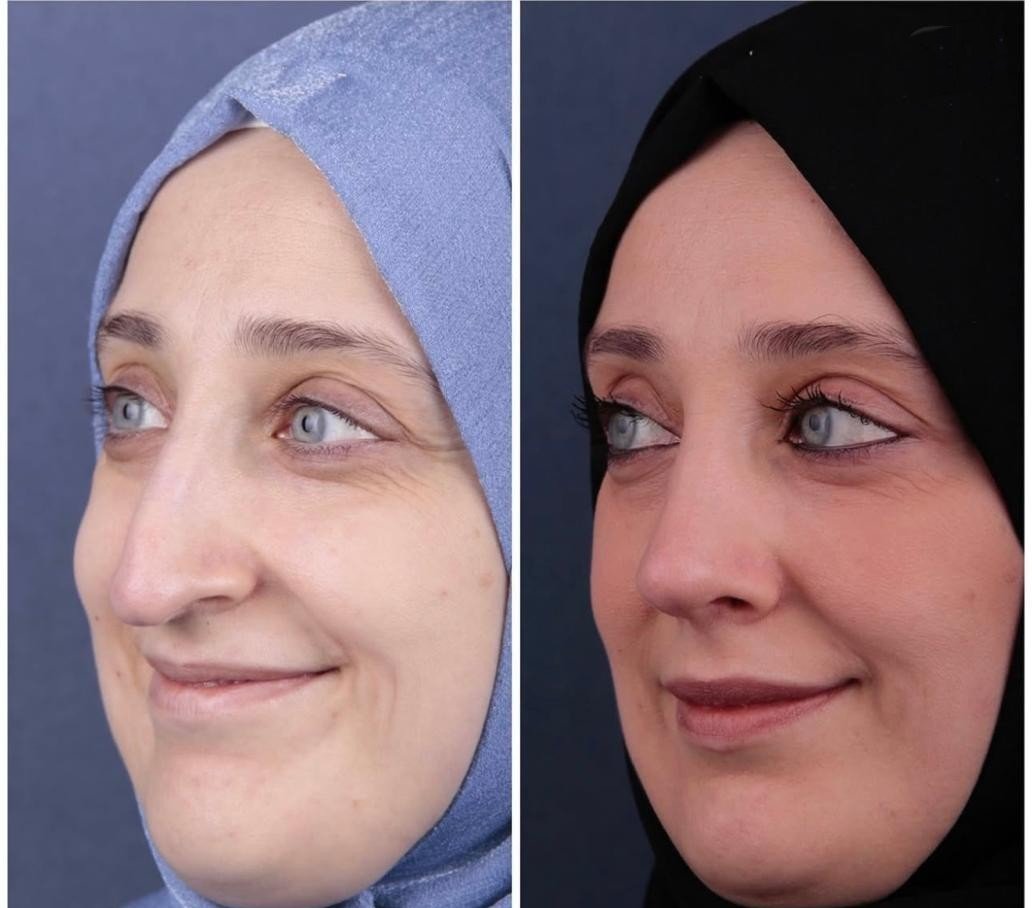 Before and after result by Dr. Yavuz Selim Yıldırım