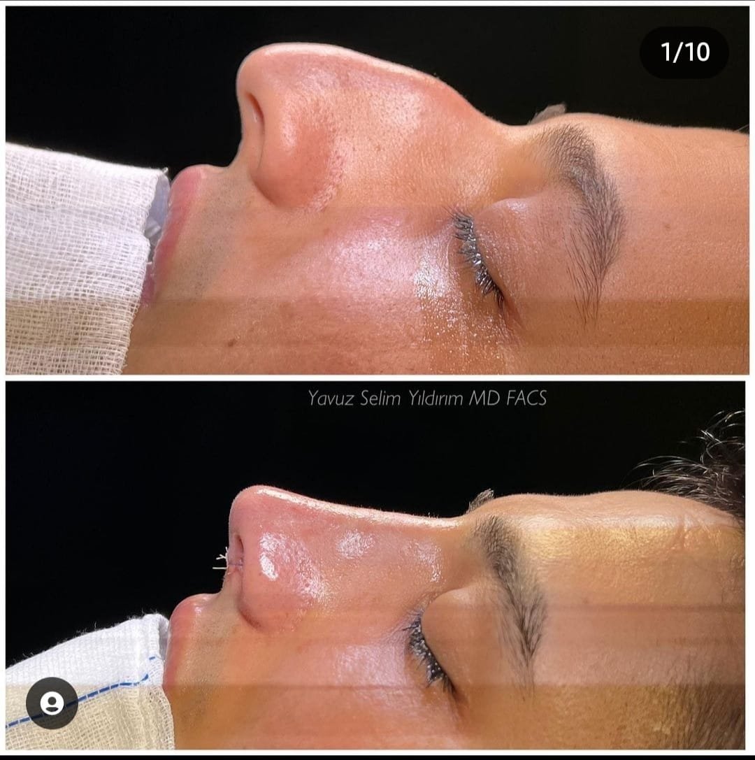 Before and after result by Dr. Yavuz Selim Yıldırım