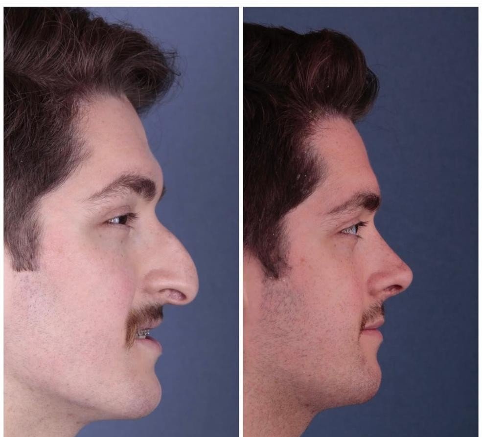 Before and after result by Dr. Yavuz Selim Yıldırım