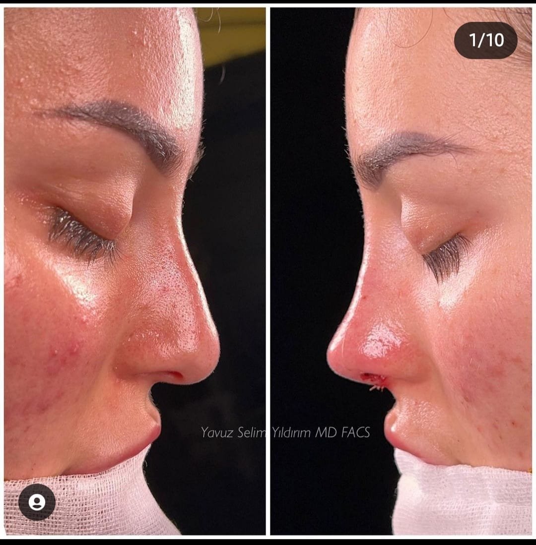 Before and after result by Dr. Yavuz Selim Yıldırım