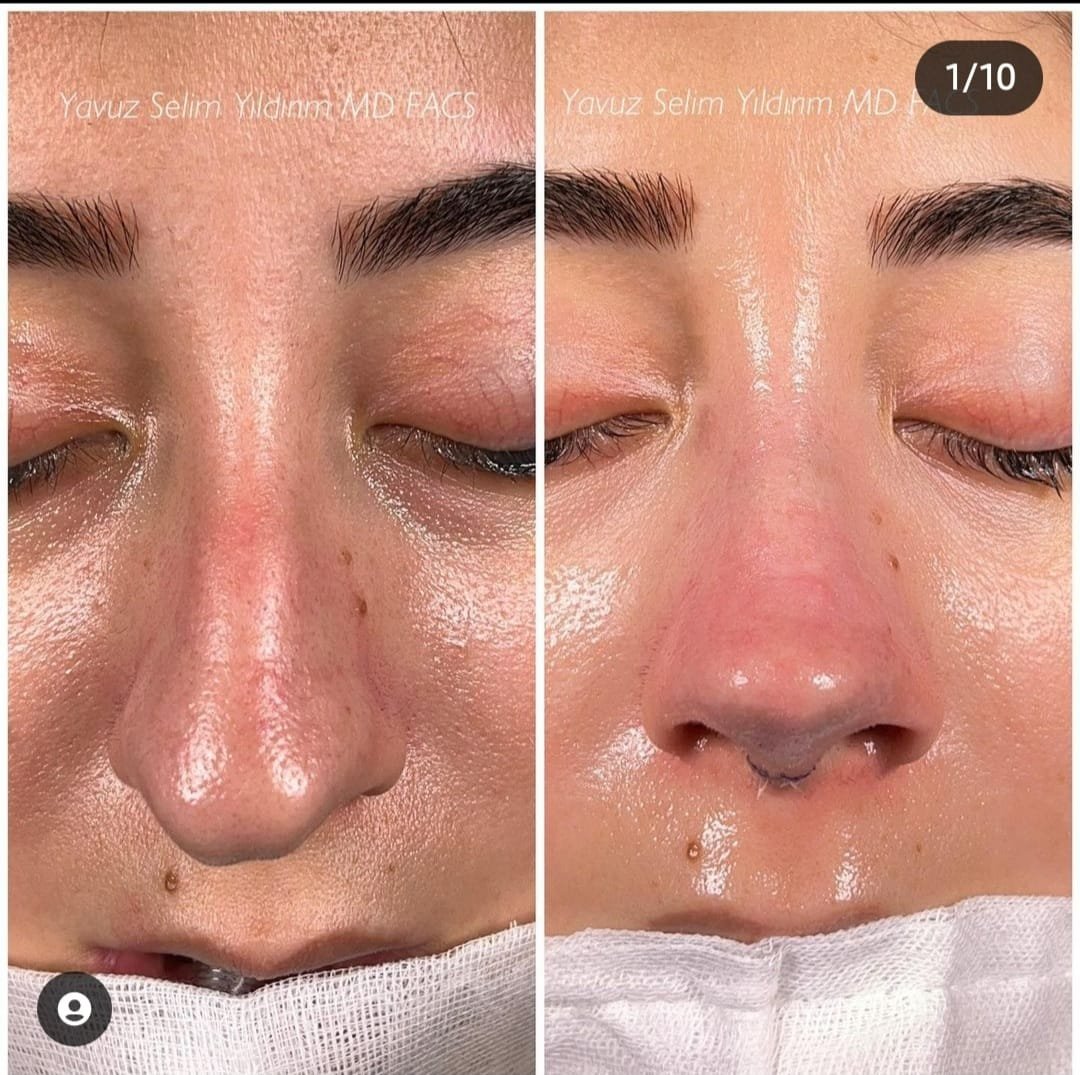 Before and after result by Dr. Yavuz Selim Yıldırım