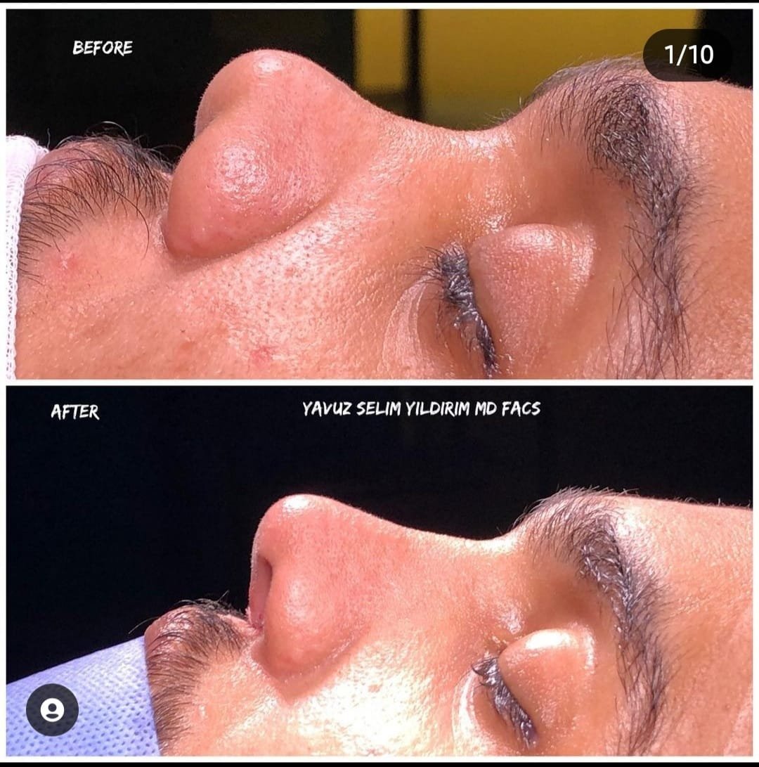 Before and after result by Dr. Yavuz Selim Yıldırım