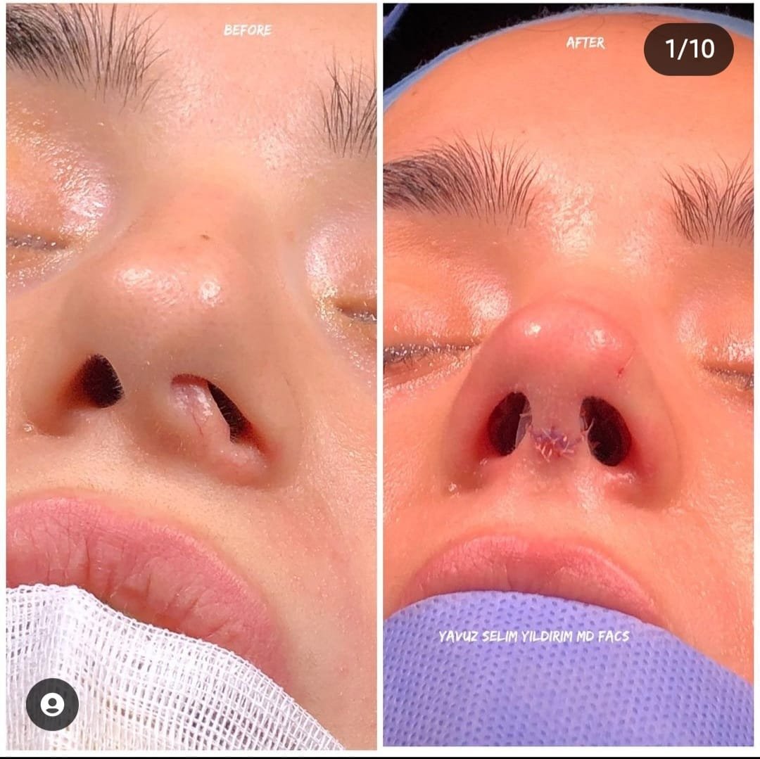 Before and after result by Dr. Yavuz Selim Yıldırım