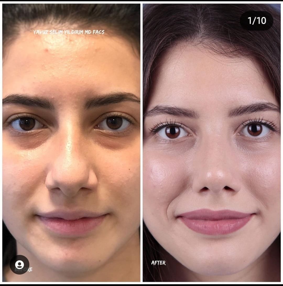 Before and after result by Dr. Yavuz Selim Yıldırım