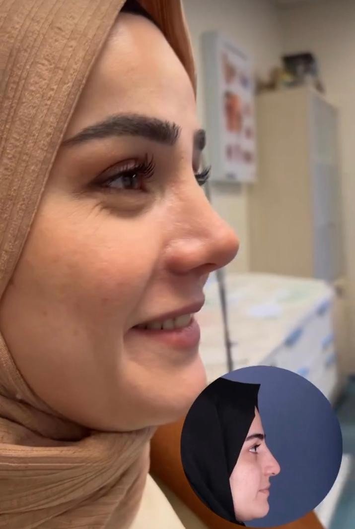 Before and after result by Dr. Yavuz Selim Yıldırım