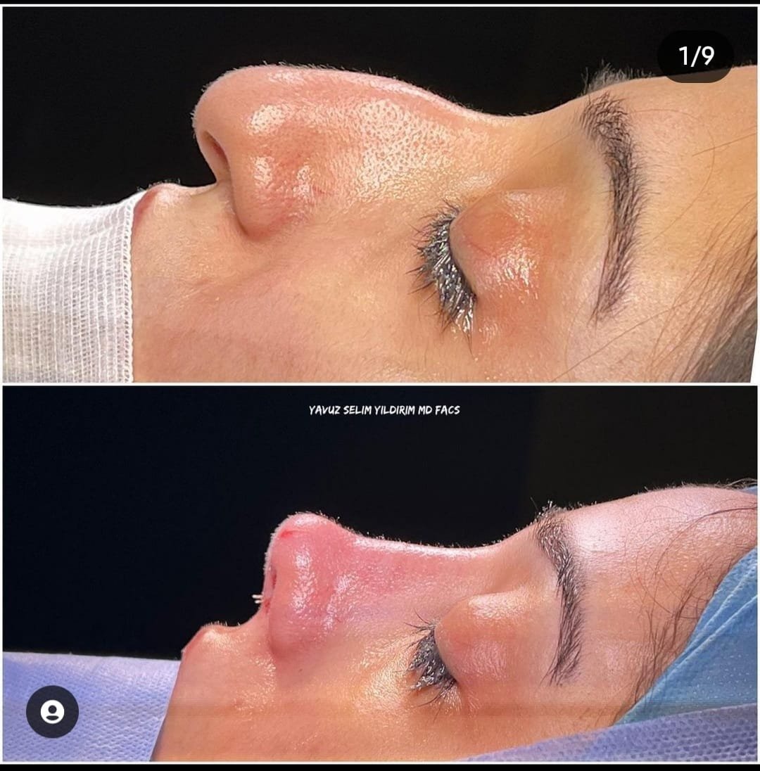Before and after result by Dr. Yavuz Selim Yıldırım