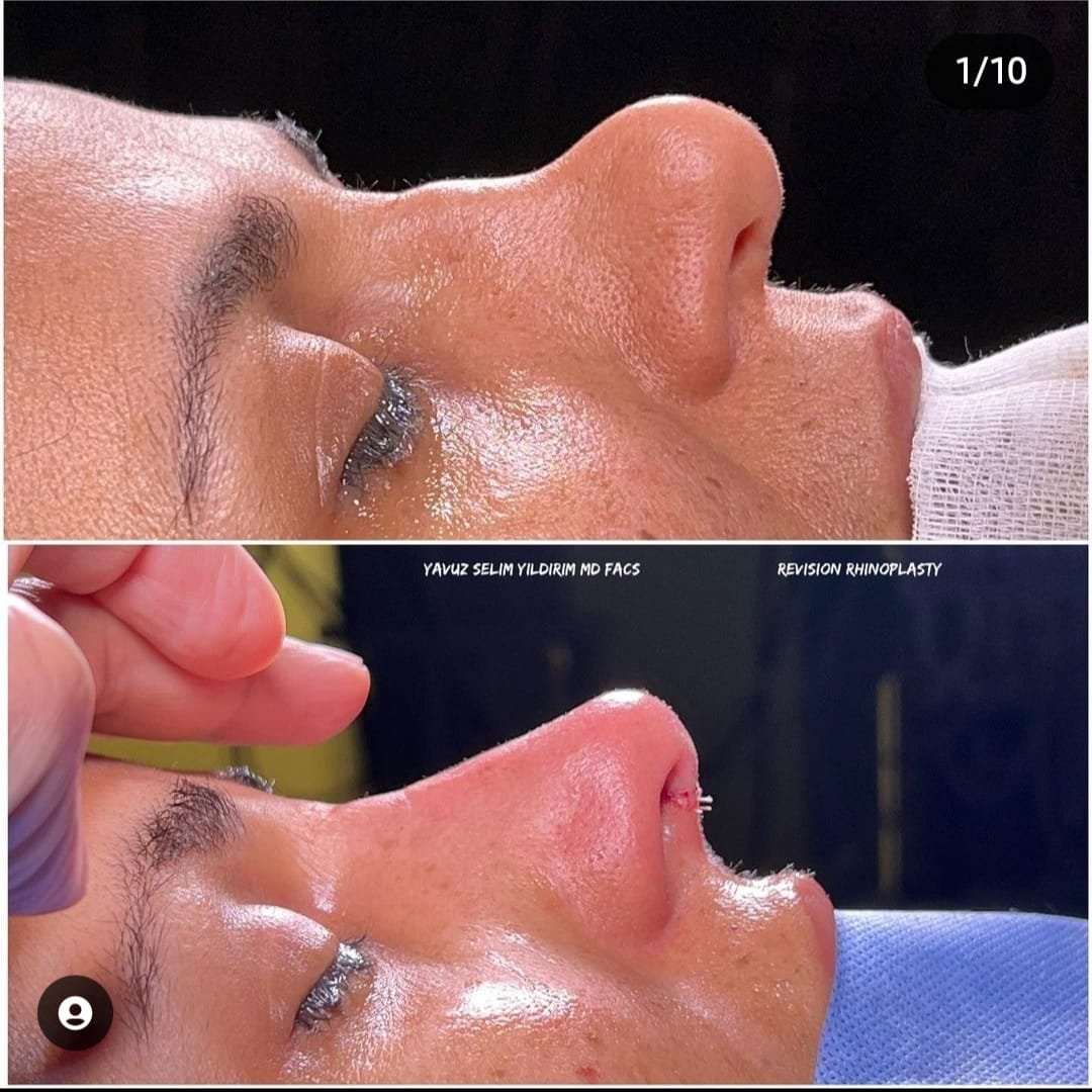 Before and after result by Dr. Yavuz Selim Yıldırım