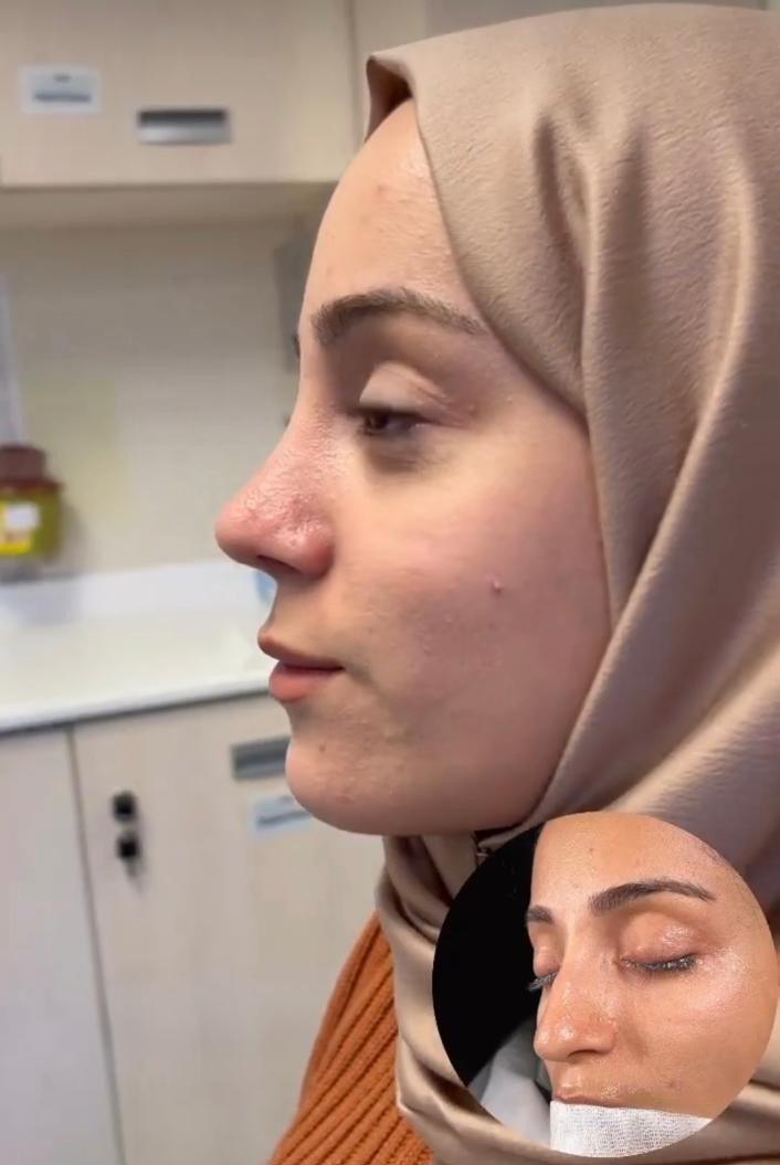 Before and after result by Dr. Yavuz Selim Yıldırım