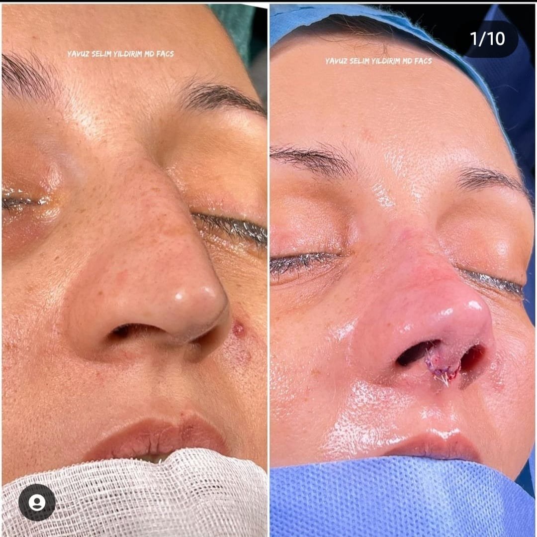Before and after result by Dr. Yavuz Selim Yıldırım