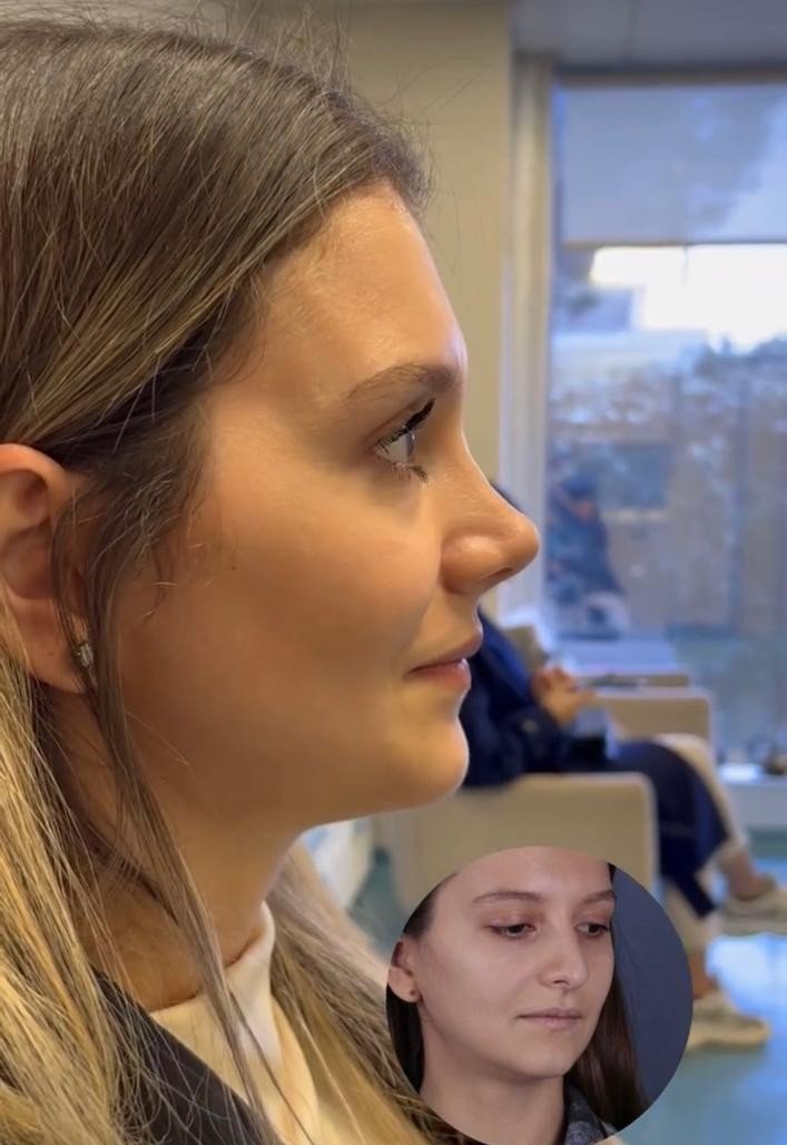 Before and after result by Dr. Yavuz Selim Yıldırım