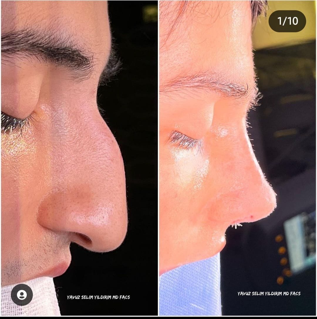 Before and after result by Dr. Yavuz Selim Yıldırım