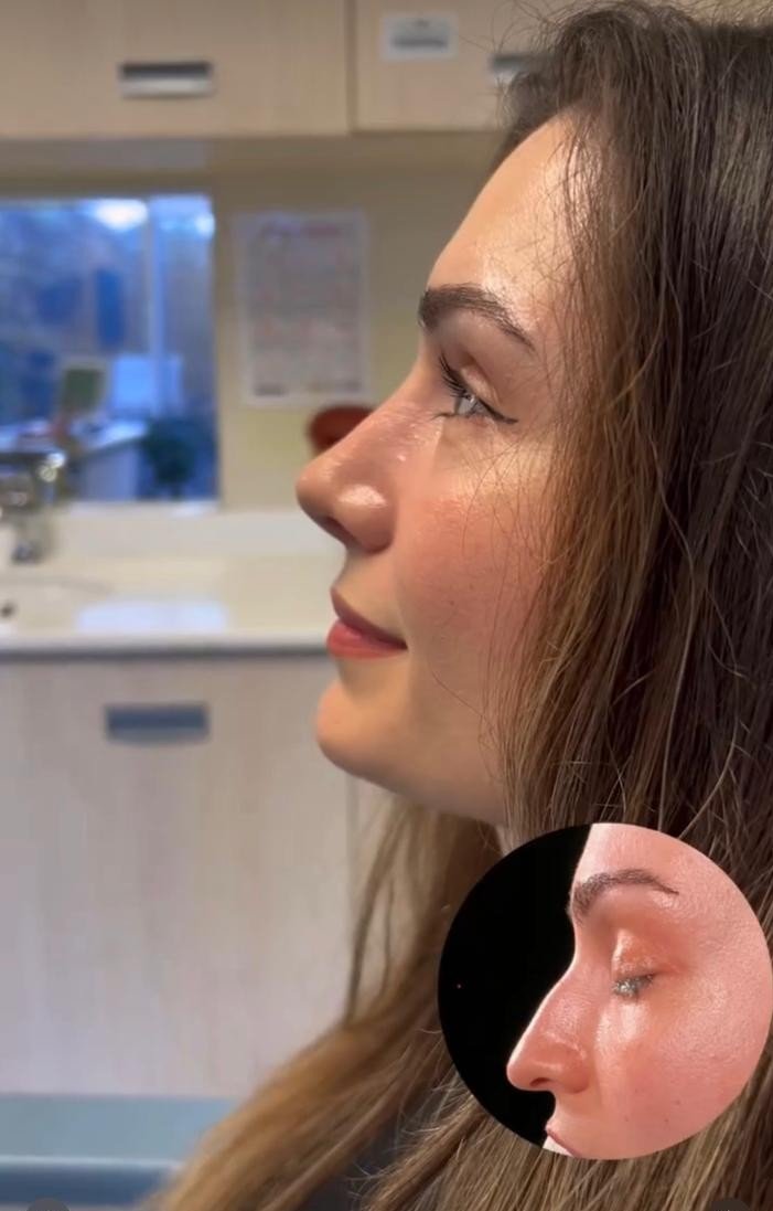 Before and after result by Dr. Yavuz Selim Yıldırım