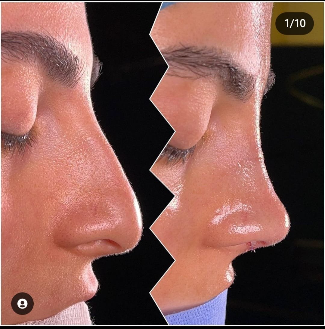 Before and after result by Dr. Yavuz Selim Yıldırım