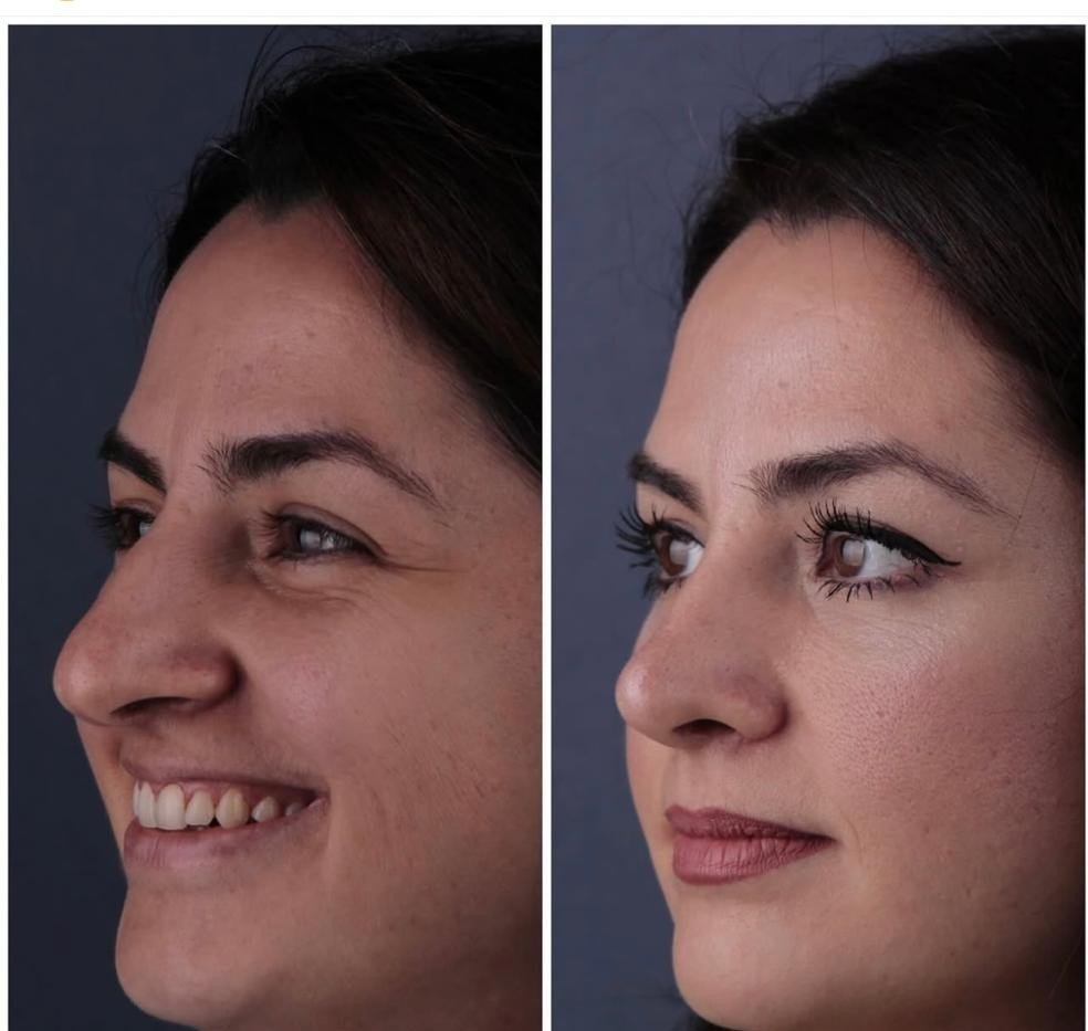 Before and after result by Dr. Yavuz Selim Yıldırım