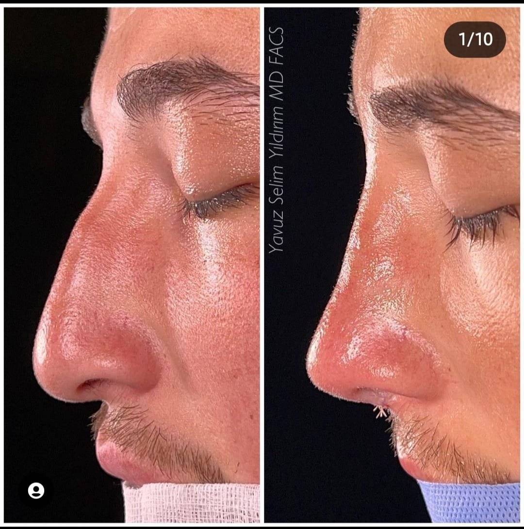 Before and after result by Dr. Yavuz Selim Yıldırım