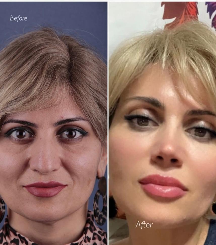 Before and after result by Dr. Yavuz Selim Yıldırım