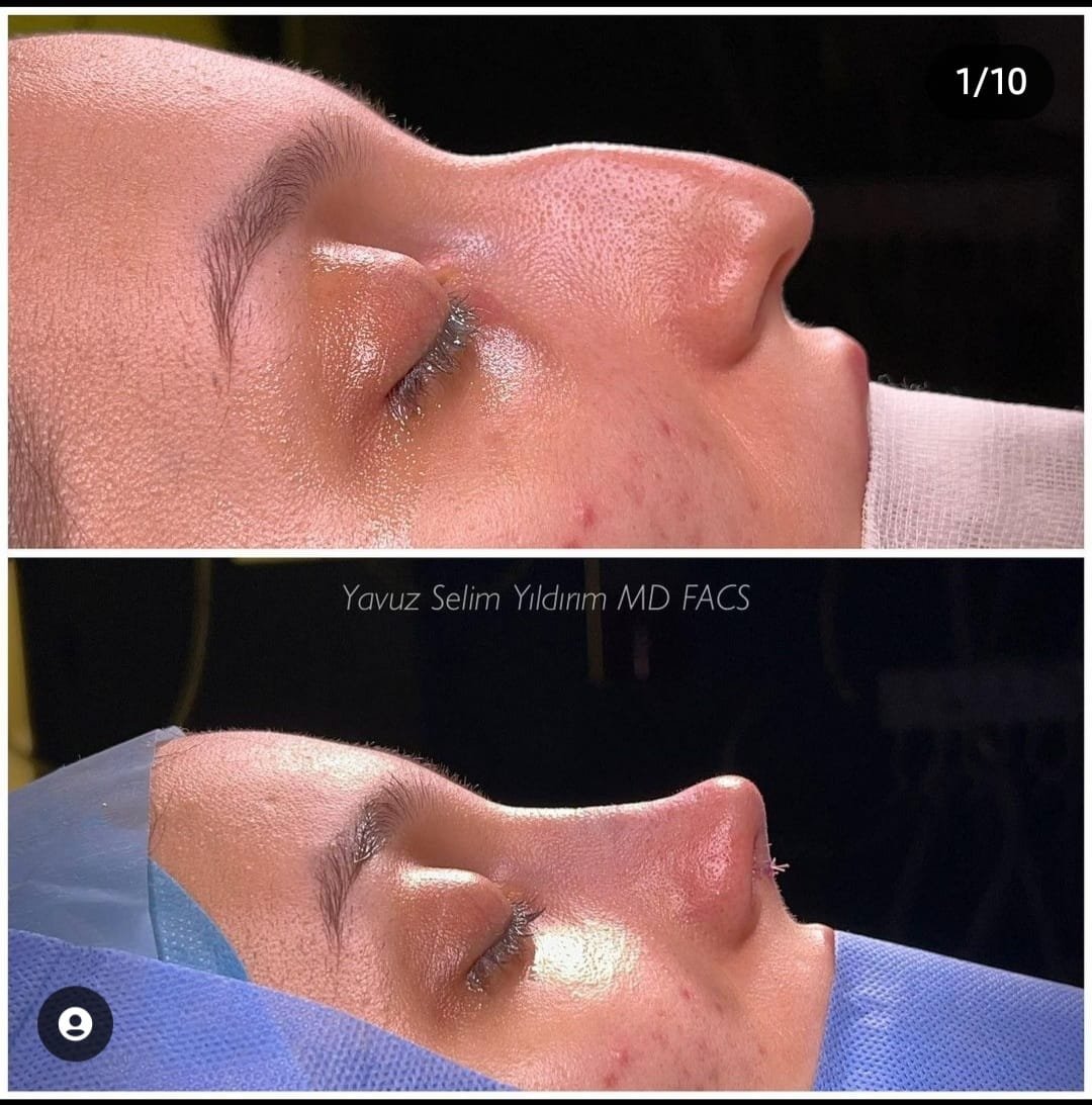 Before and after result by Dr. Yavuz Selim Yıldırım
