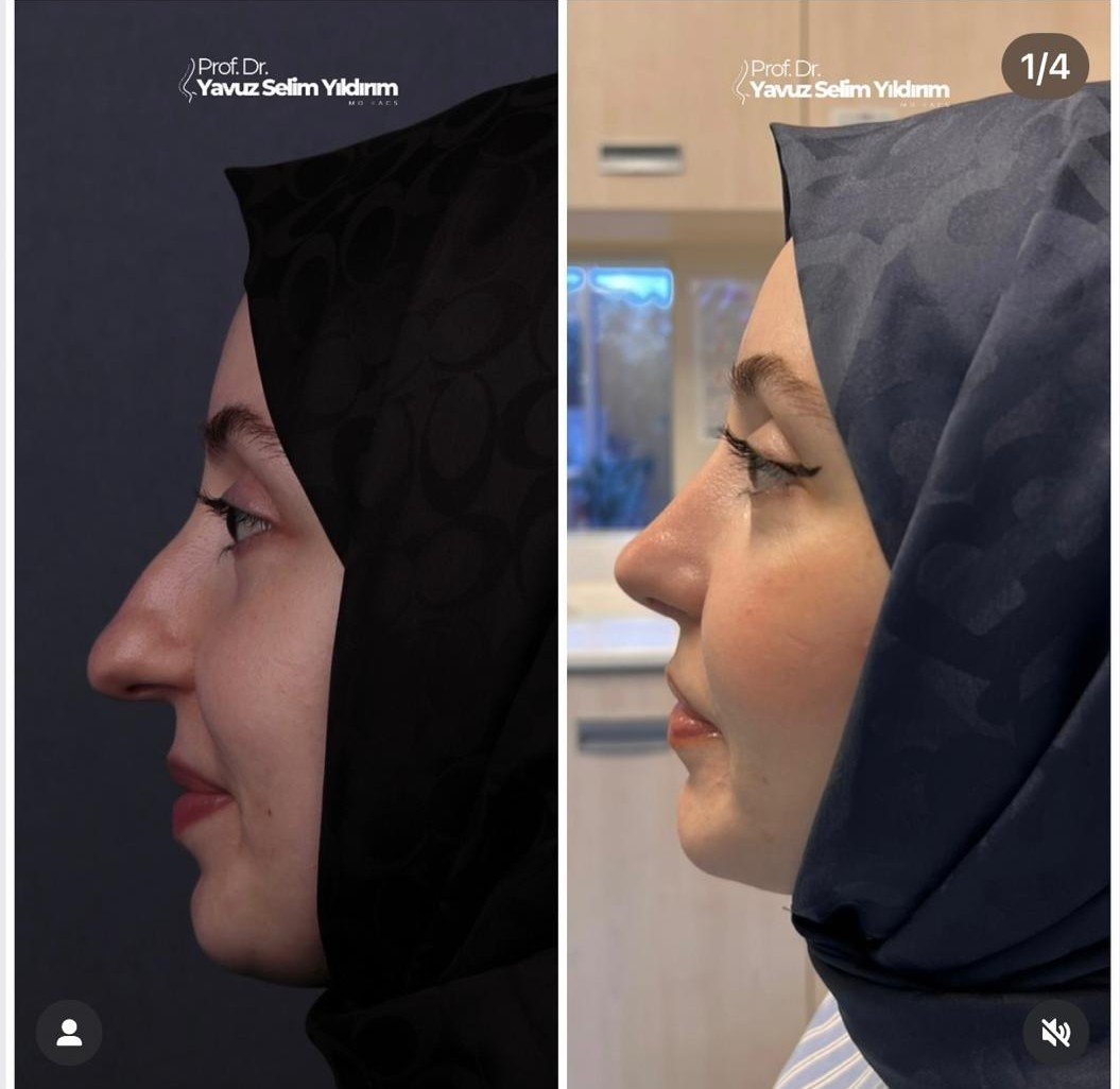 Before and after result by Dr. Yavuz Selim Yıldırım