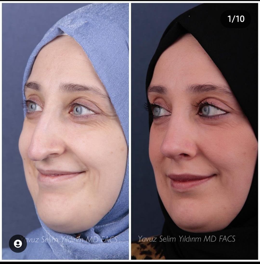 Before and after result by Dr. Yavuz Selim Yıldırım