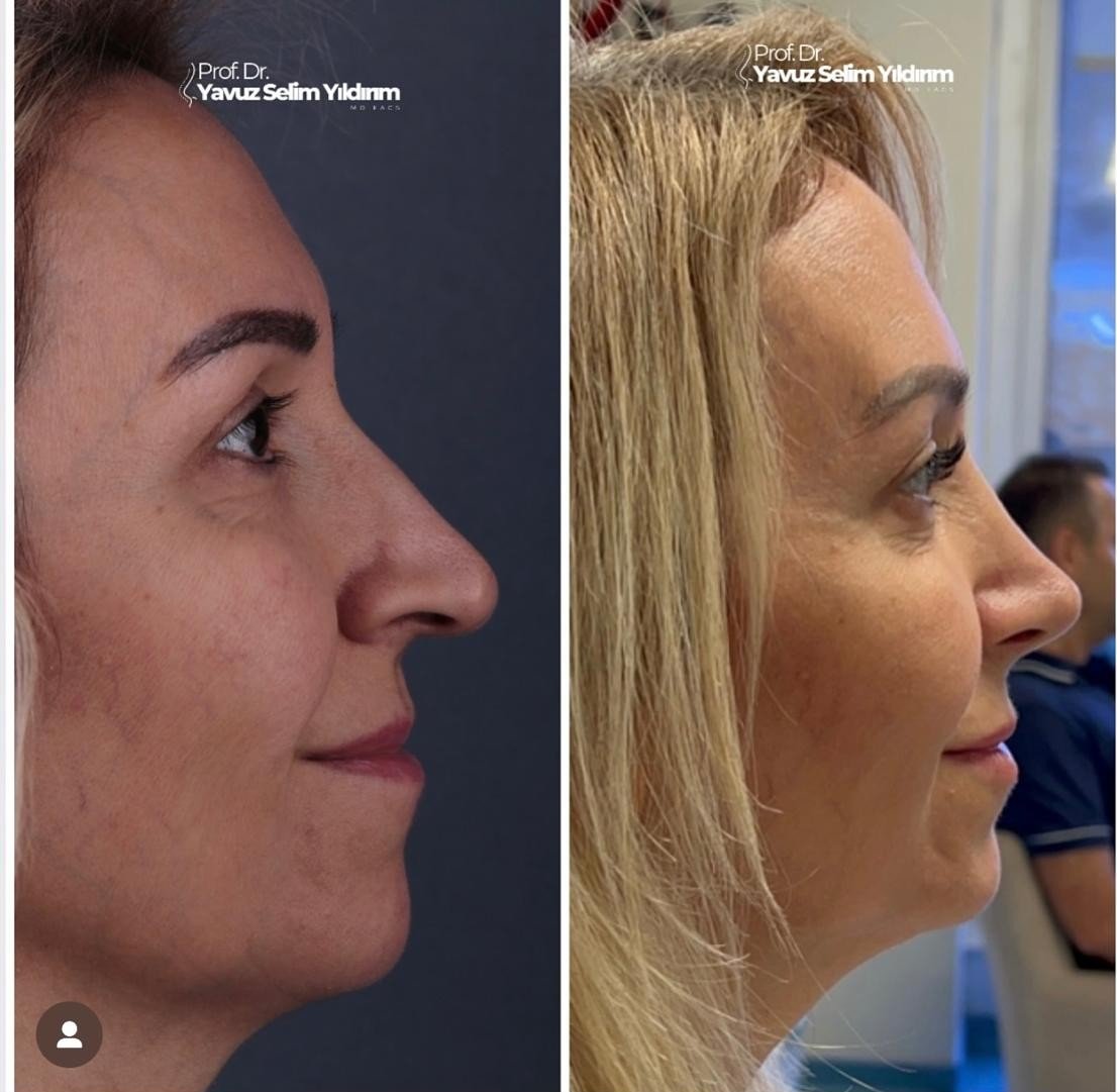 Before and after result by Dr. Yavuz Selim Yıldırım