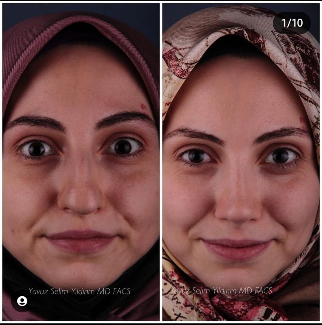 Before and after result by Dr. Yavuz Selim Yıldırım