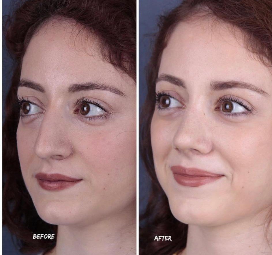 Before and after result by Dr. Yavuz Selim Yıldırım
