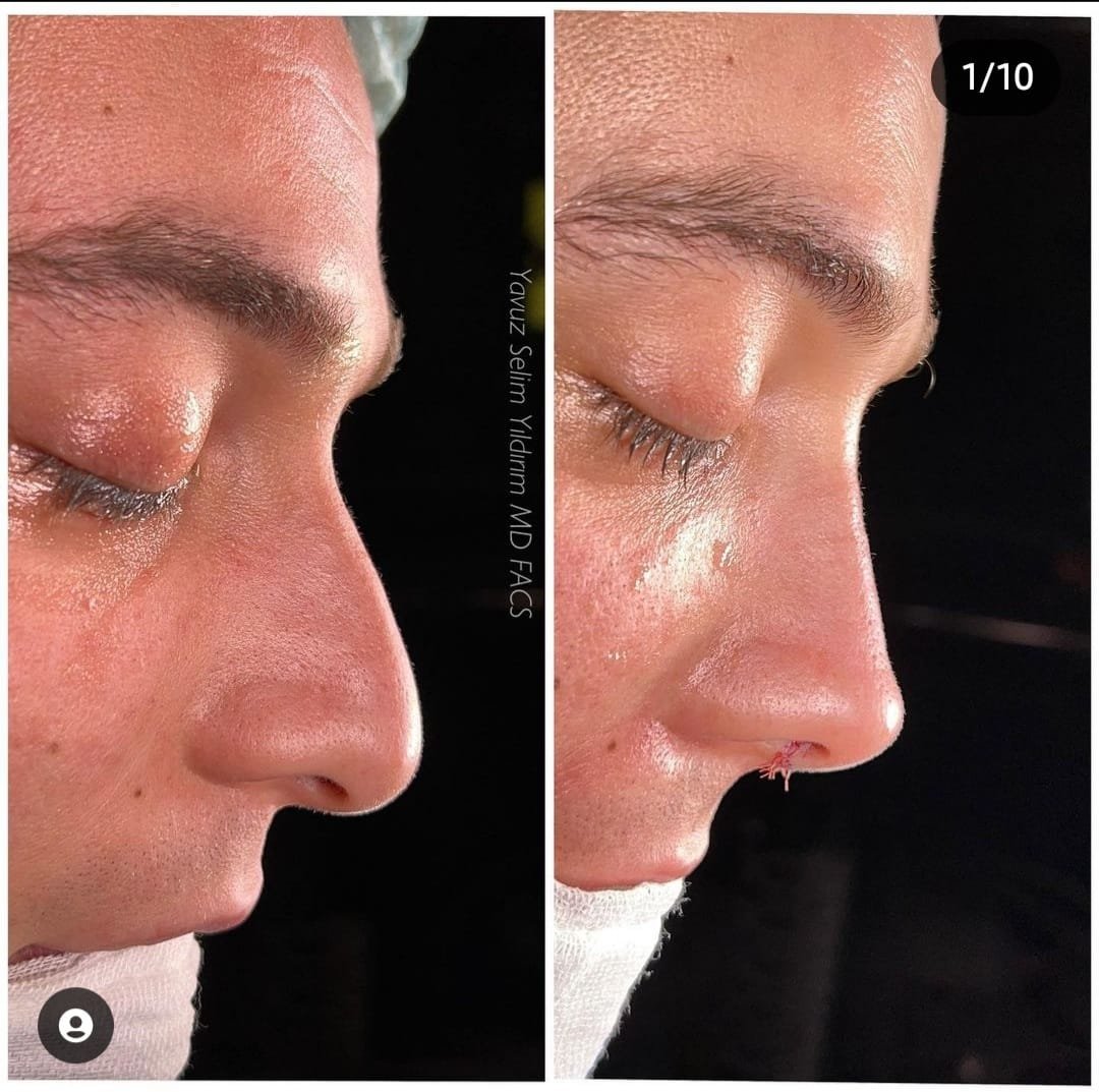 Before and after result by Dr. Yavuz Selim Yıldırım