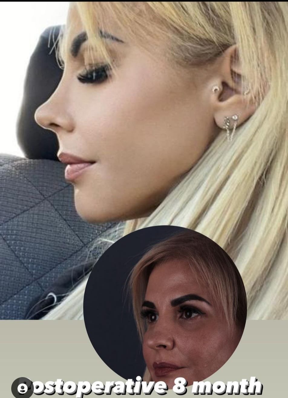 Before and after result by Dr. Yavuz Selim Yıldırım