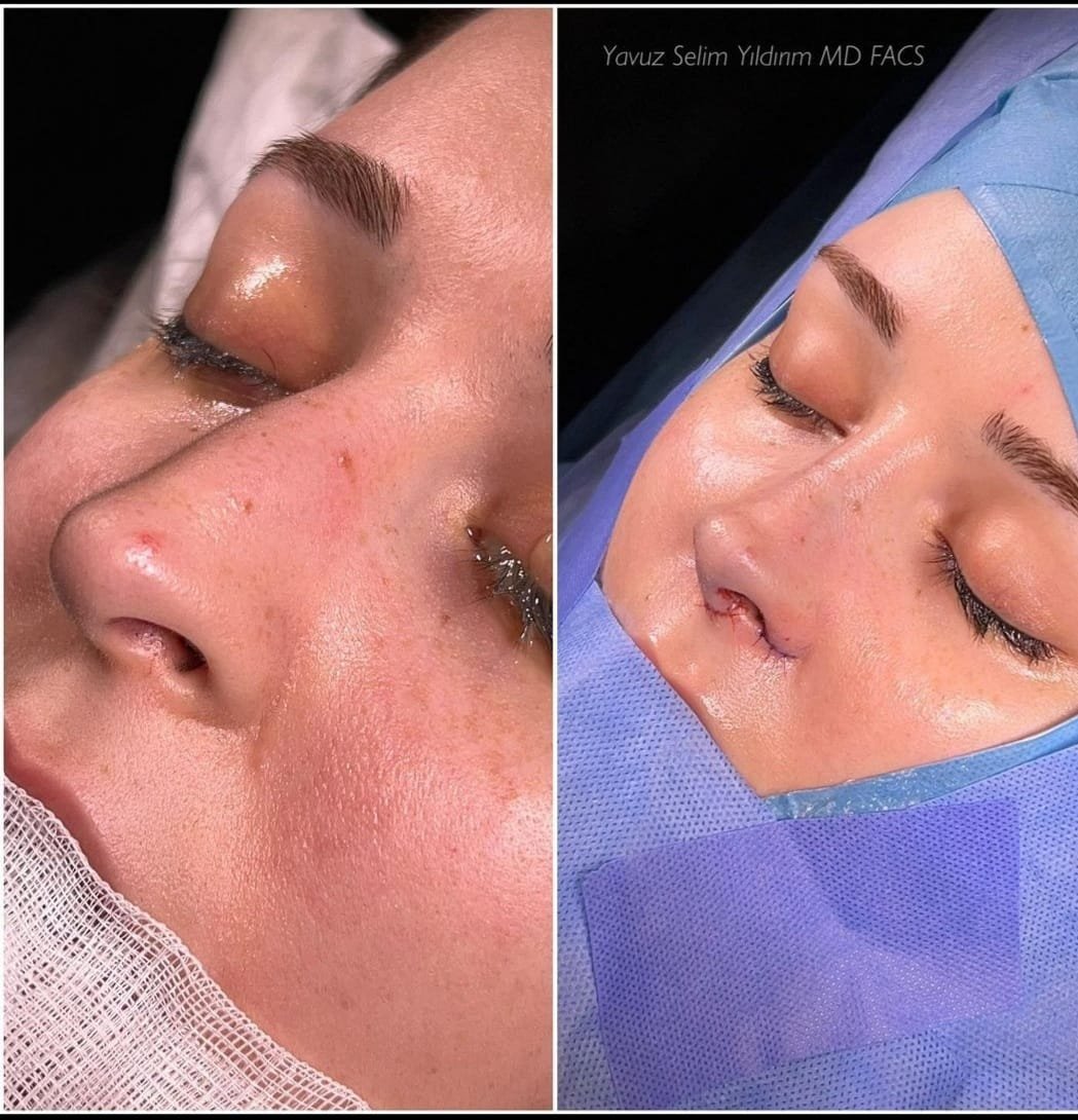 Before and after result by Dr. Yavuz Selim Yıldırım