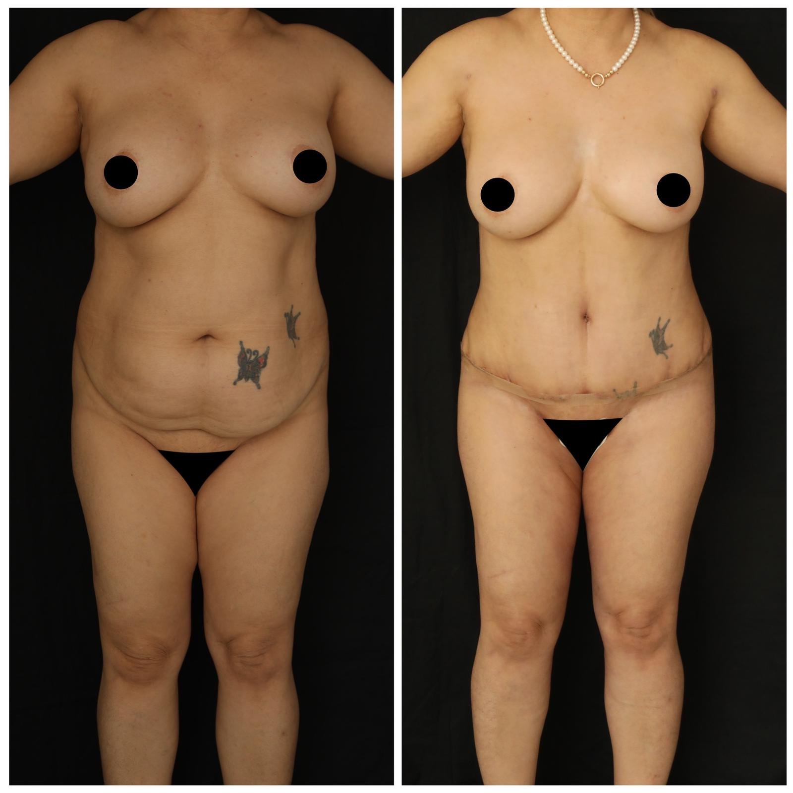 Before and after result by Dr. Yurdakul İlker Manavbasi