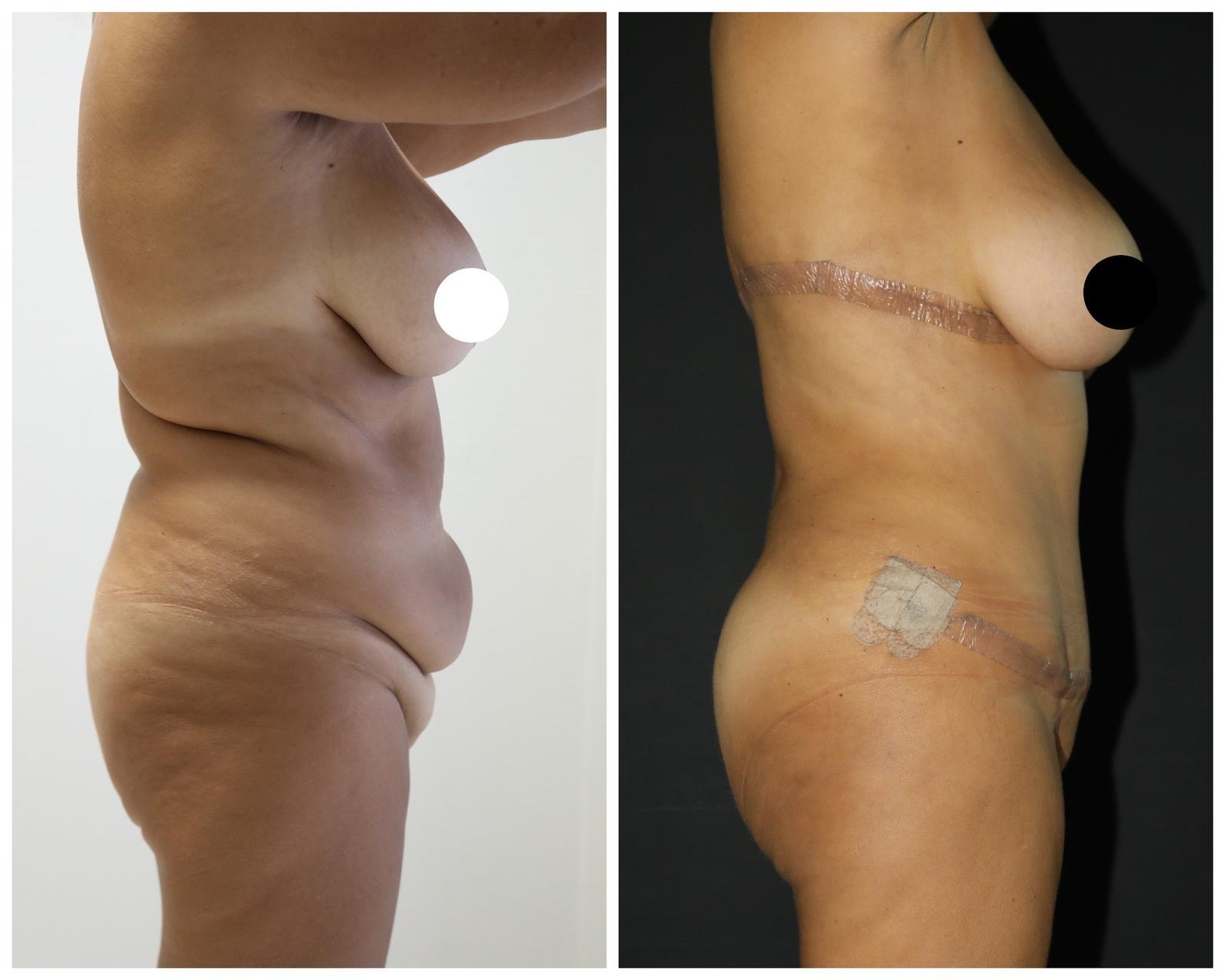 Before and after result by Dr. Yurdakul İlker Manavbasi