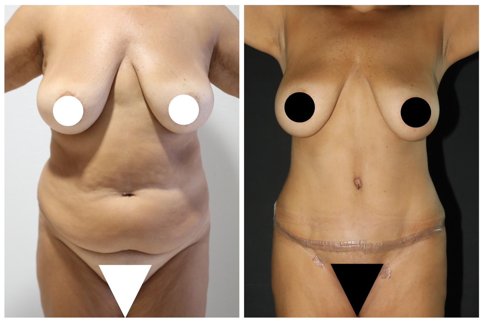 Before and after result by Dr. Yurdakul İlker Manavbasi