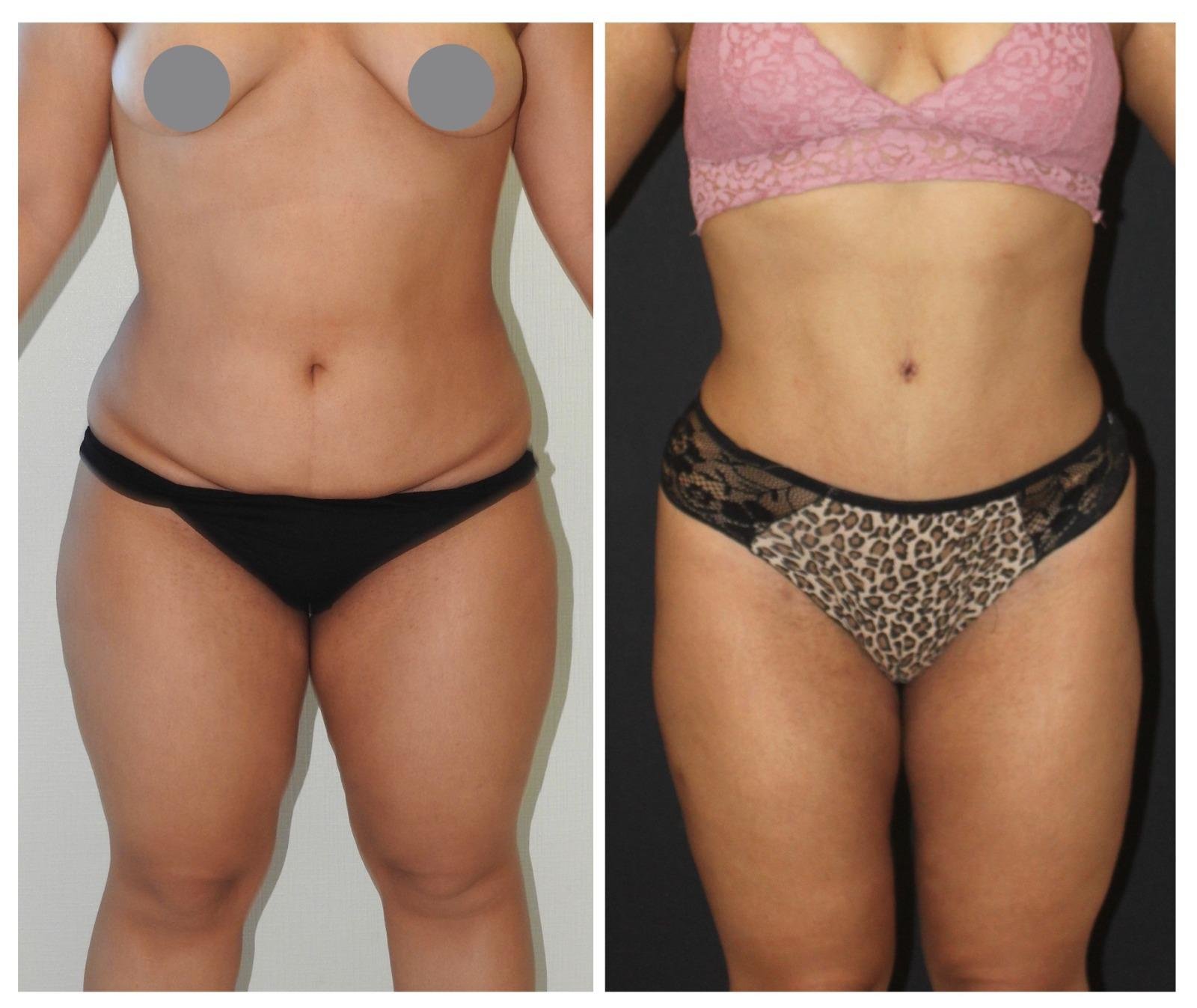 Before and after result by Dr. Yurdakul İlker Manavbasi
