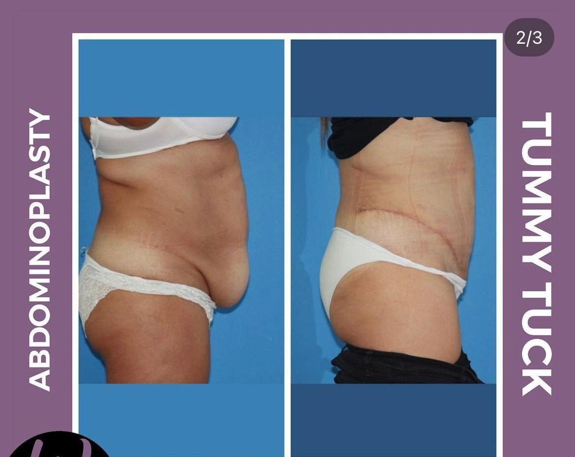 Before and after result by Dr. Yurdakul İlker Manavbasi