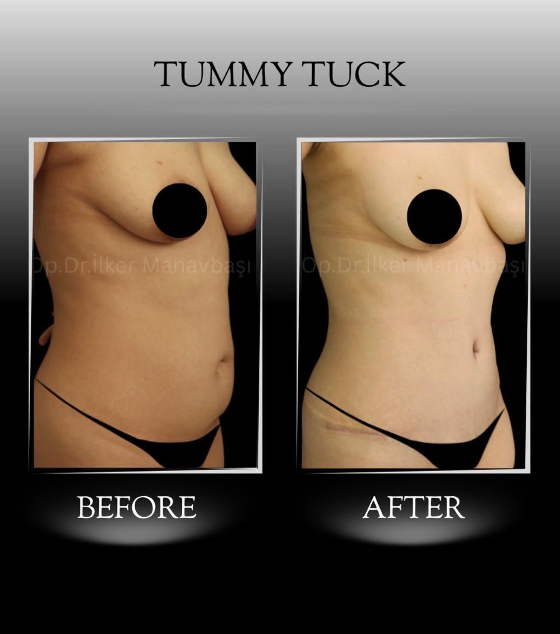 Before and after result by Dr. Yurdakul İlker Manavbasi