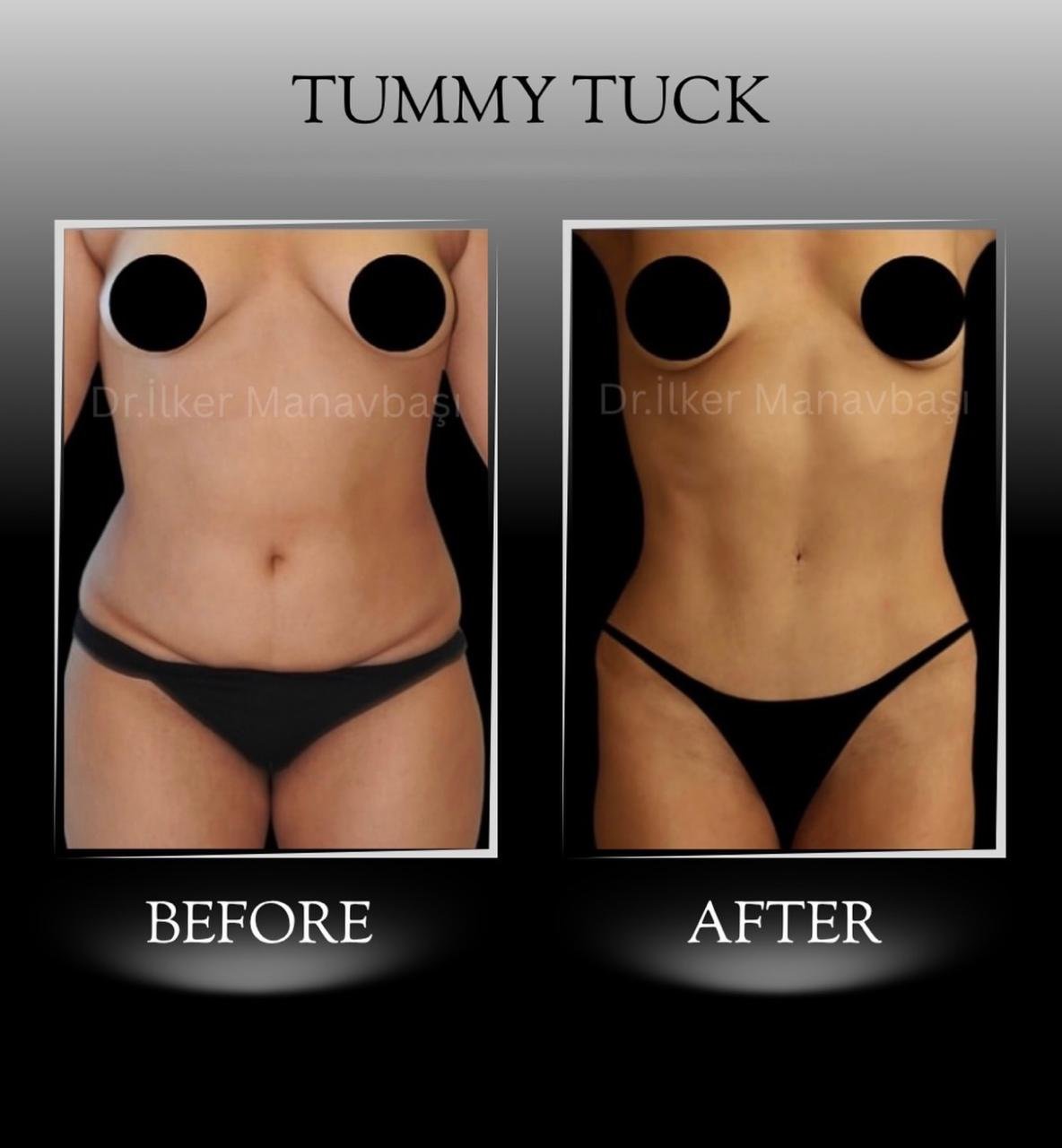 Before and after result by Dr. Yurdakul İlker Manavbasi