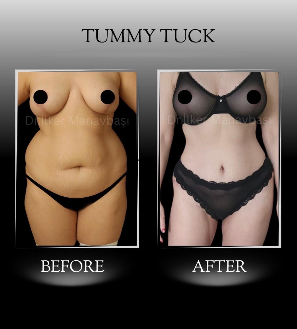 Before and after result by Dr. Yurdakul İlker Manavbasi