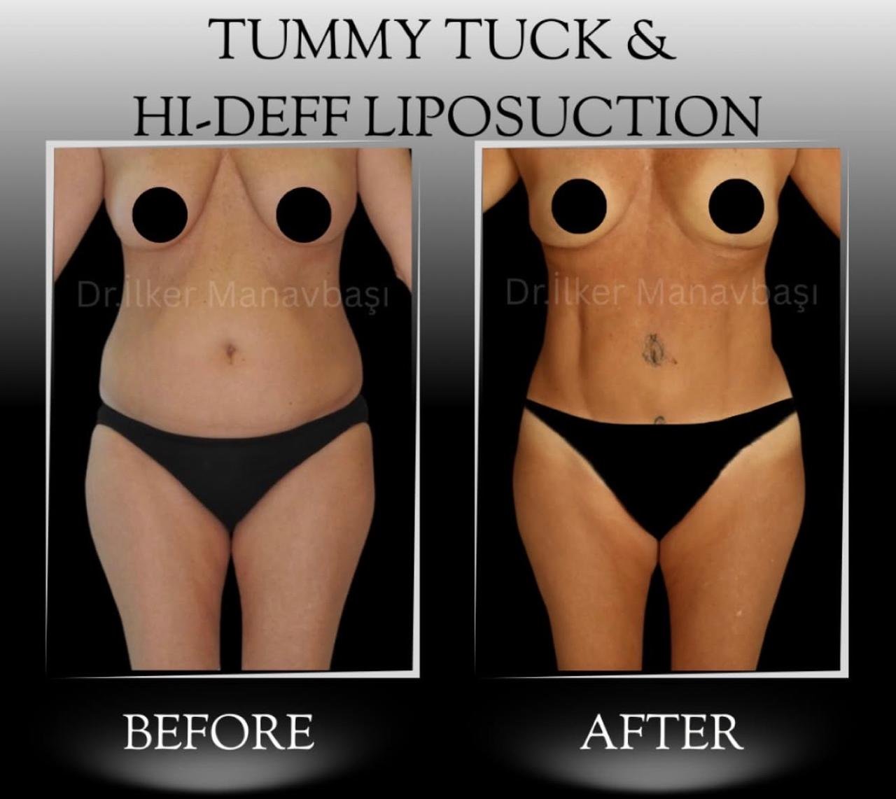 Before and after result by Dr. Yurdakul İlker Manavbasi