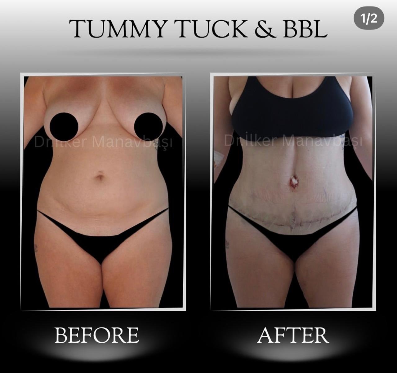 Before and after result by Dr. Yurdakul İlker Manavbasi