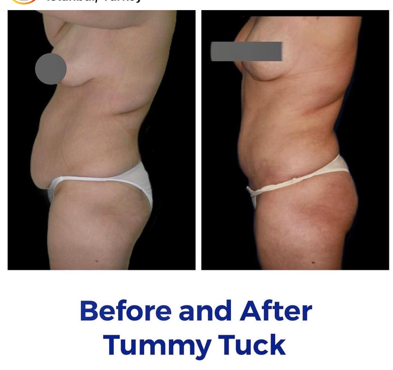 Before and after result by Dr. Yurdakul İlker Manavbasi