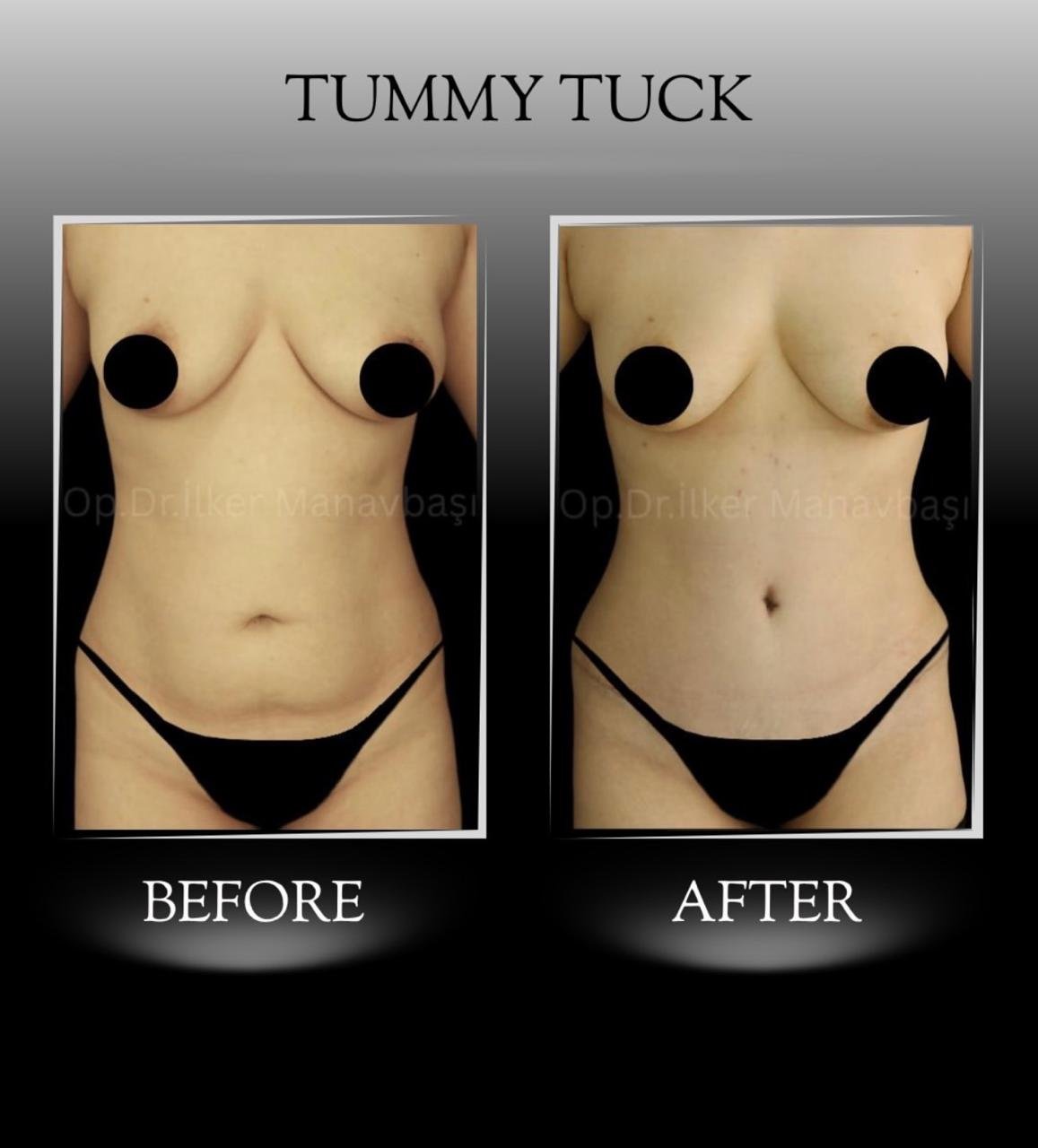 Before and after result by Dr. Yurdakul İlker Manavbasi