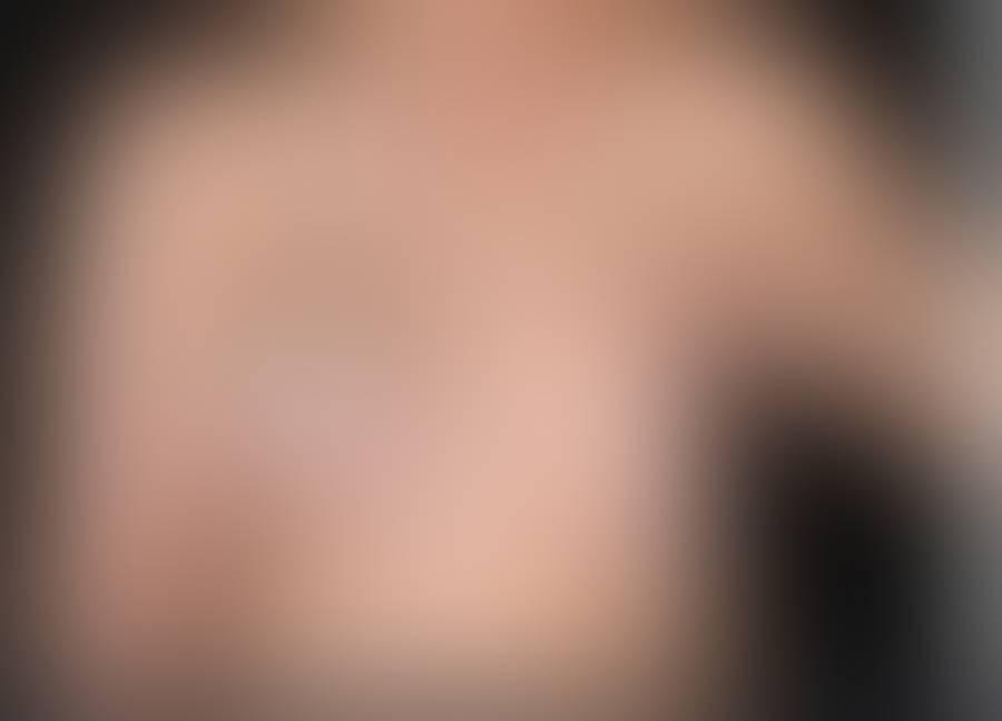 Breast Reduction before and after by Selçuk Aytaç