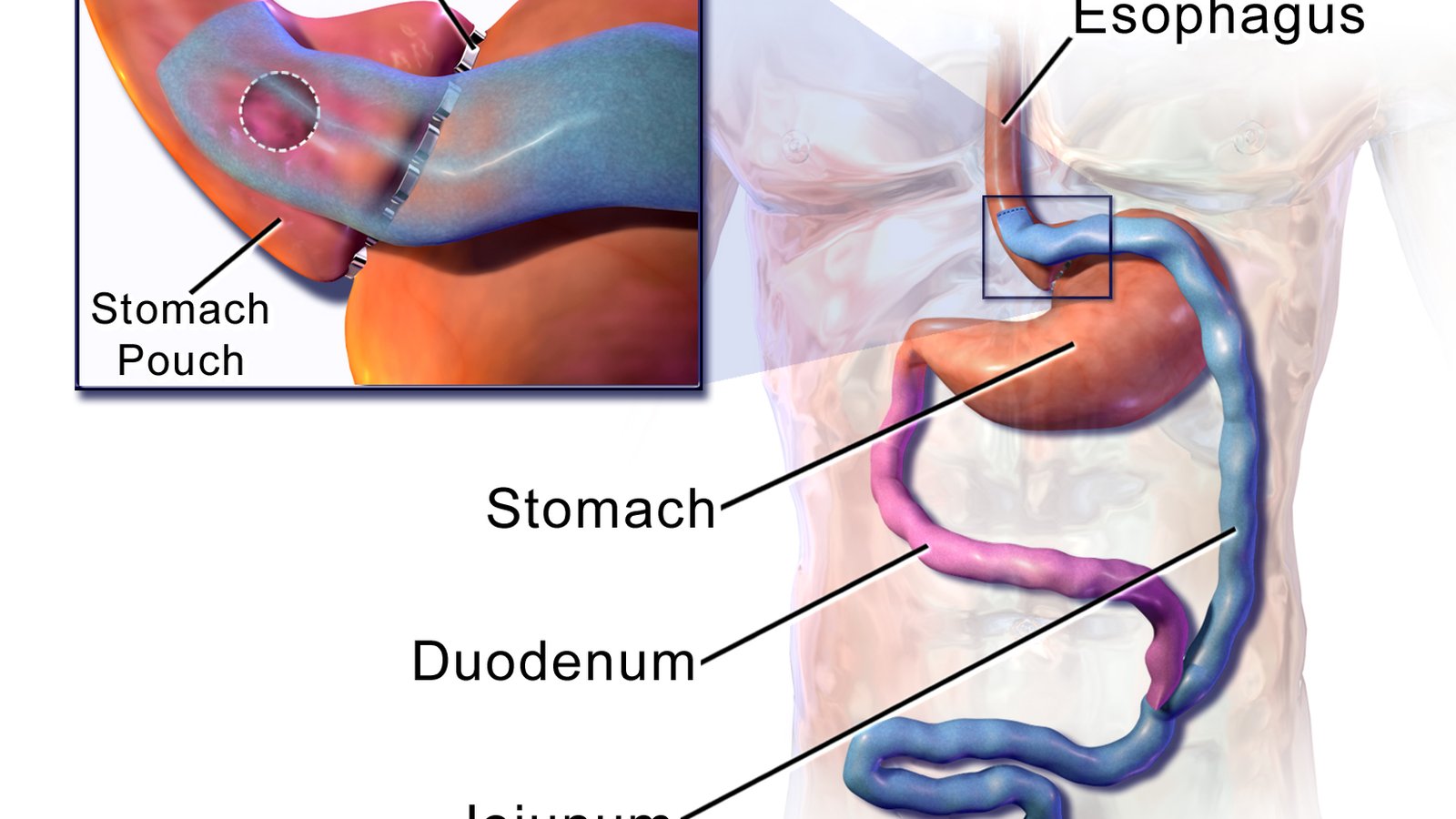 Bariatric Surgery (Gastric Sleeve/Bypass)