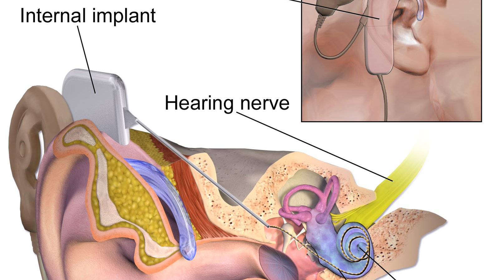 Cochlear Implant