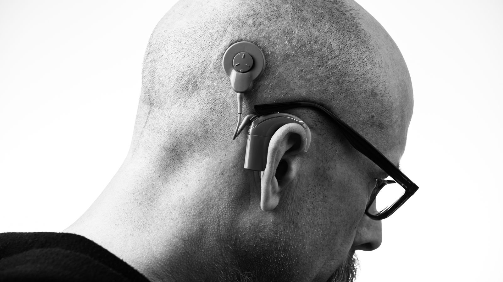 Cochlear Implant